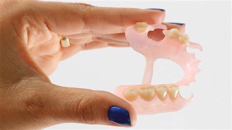 prótese dentária de silicone flexível fotos Essas próteses ficam fixas na boca e são conjuntos de coroas dentais, presas sobre dentes ou implantes, feitas de porcelana